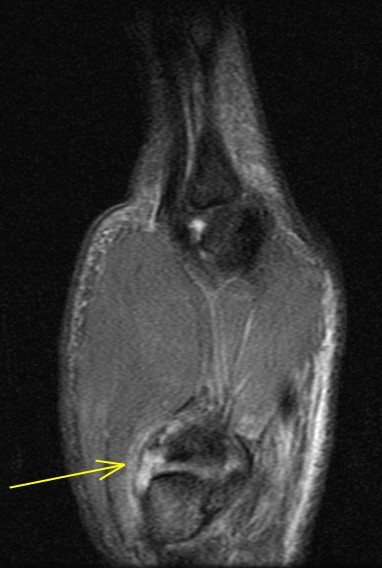 Figure 2 for case trapeziometacarpal dislocation